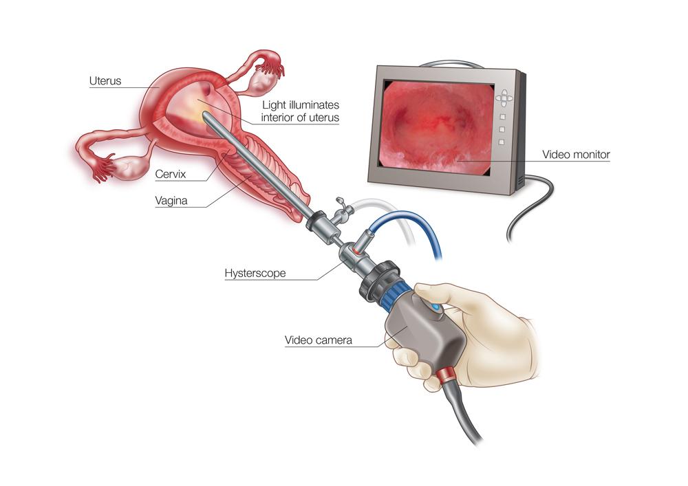 Hysteroscopy