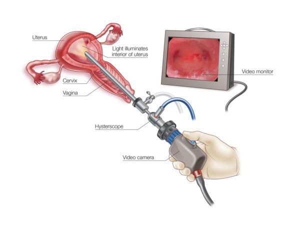 Hysteroscopy